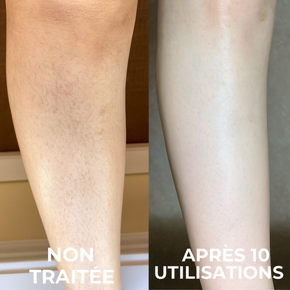 Strawbeauty - crème d'acide triple avancé pour la kératose pilaire